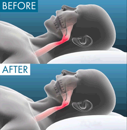 Before and after illustration of the airway with the mouthpiece